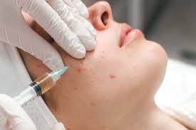 ACNE INJECTION by Bali Beauty Center